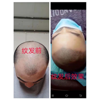广西纹发治疗脱发的几种方法，