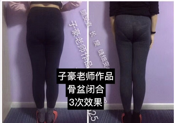 徒手整形