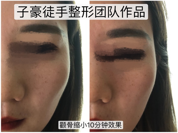 日式小颜整骨