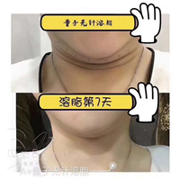 量子无针微整怎么加盟 