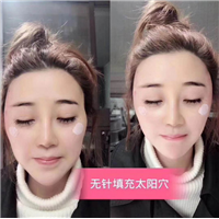 量子无针填充太阳穴 