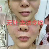 量子无针微整加盟