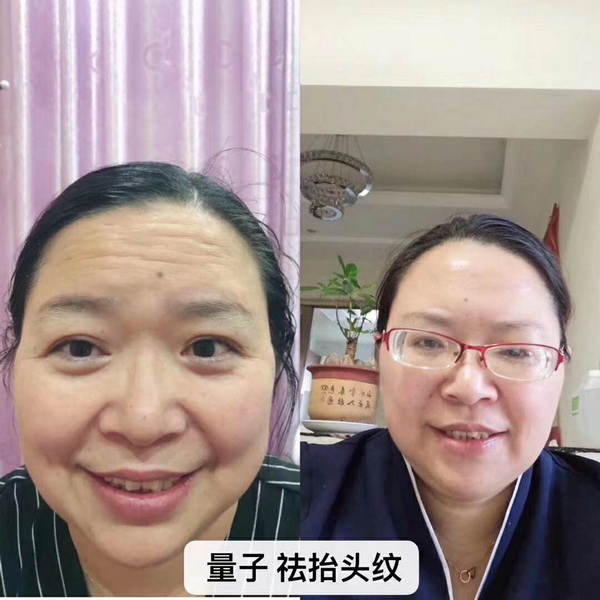 量子无针微整效果对比 