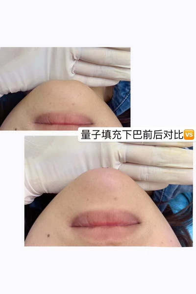 量子无针微整加盟 