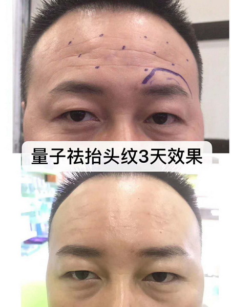 量子无针微整培训哪家好 