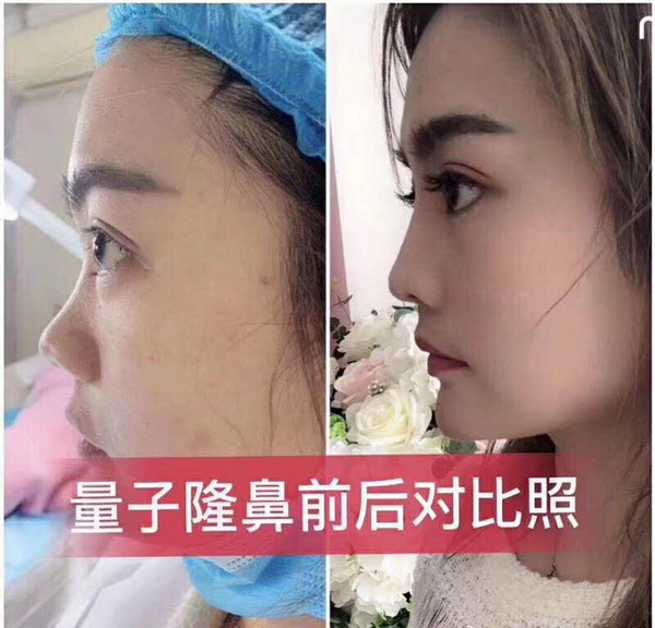 量子无针微整是什么 