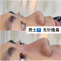 量子无针微整隆鼻效果 