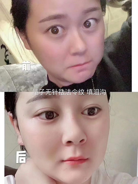 量子无针微整学校 