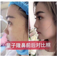 量子无针微整是什么 
