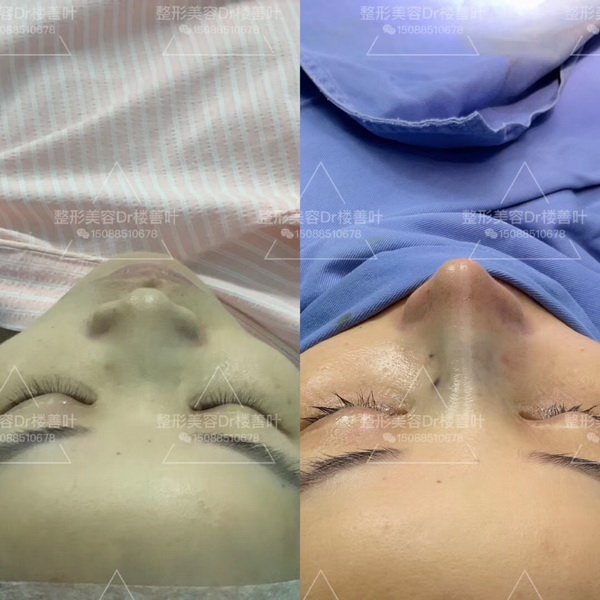 为什么我想要自然风，医生还鼓励我做欧美鼻型？ 