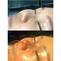 楼善叶案例