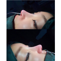 楼善叶医生@楼善叶鼻综合做的怎么样？ 