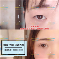 日式无痕双眼皮**吗