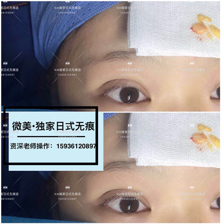 郑州无痕双眼皮专利