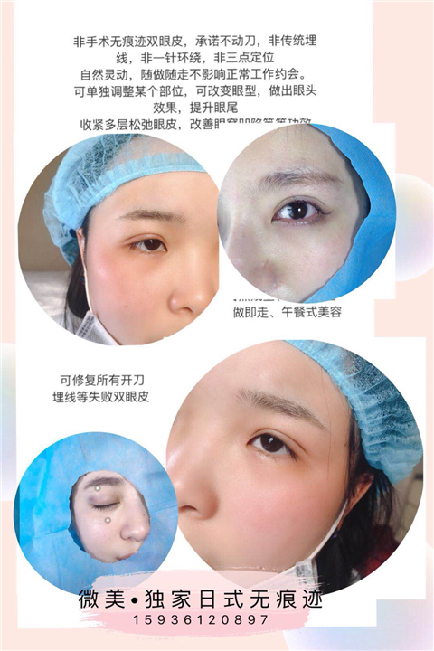 ****无痕双眼皮