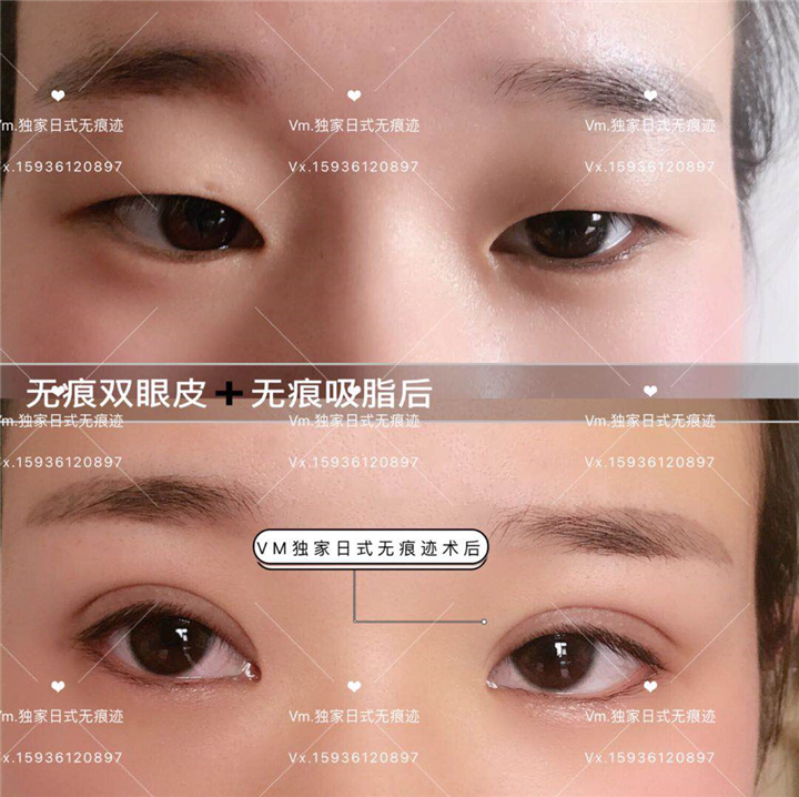 日无痕双眼皮