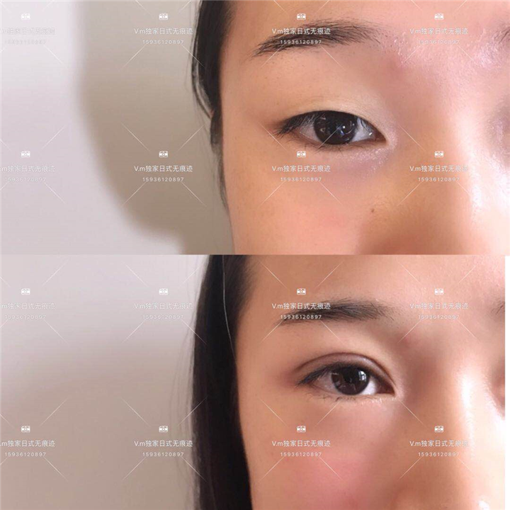 无痕双眼皮提升
