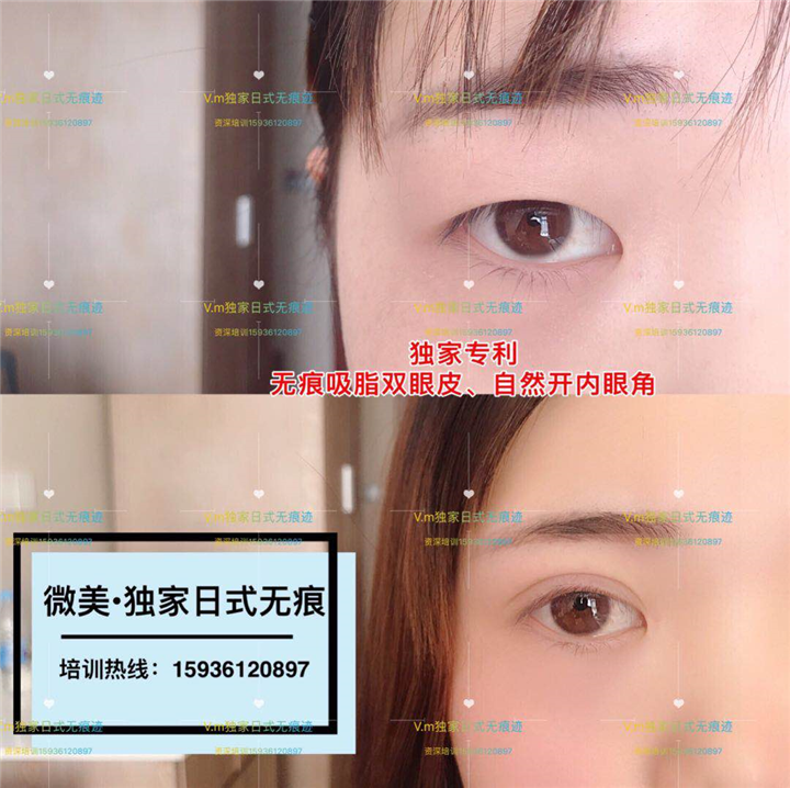 日式无痕双眼皮**吗