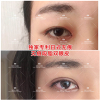 日式无痕双眼皮去哪学