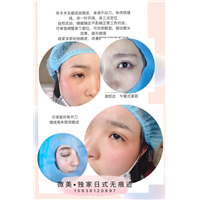 ****无痕双眼皮