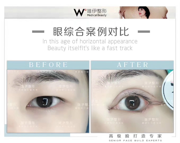 广州眼综合整形价格 