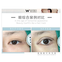 广州眼综合整形专家 