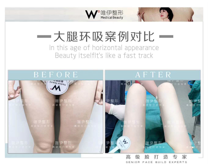 广州大腿环吸整形 