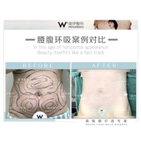 广州腰腹环吸整形 