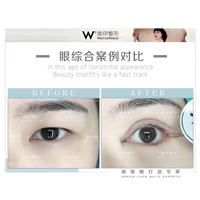广州眼综合整形价格 