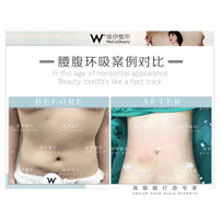 广州唯伊腰腹环吸整形多少钱