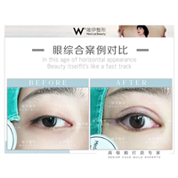 广州眼综合整形哪家好 