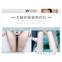 广州大腿环吸整形 