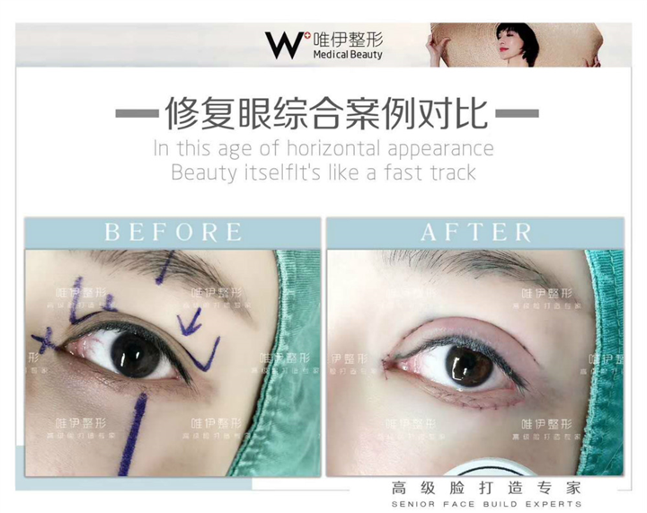 广州修复眼综合整形 