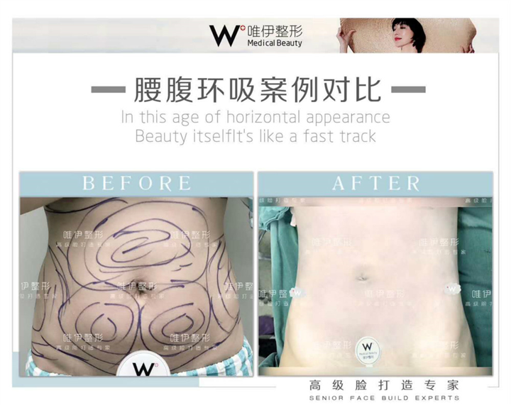 广州腰腹环吸整形 