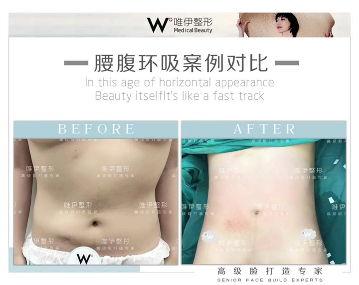 广州唯伊腰腹环吸整形多少钱 