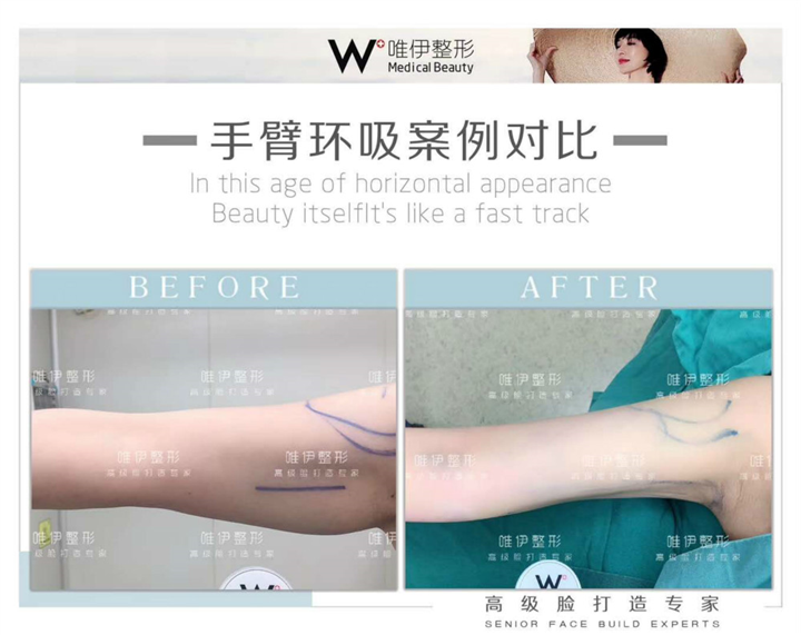 广州手臂环吸整形 