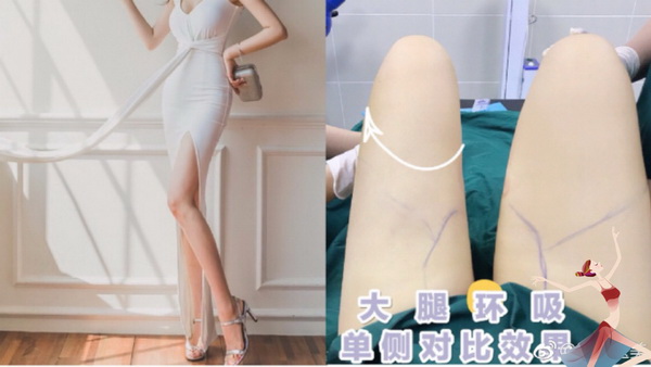 南宁大腿抽脂哪家好
