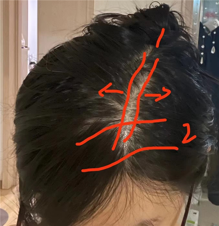 纹发“四大优势”  脱发、秃头者的福音！-北京秃乐纹发-