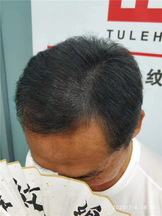 【四川纹发电话】四川纹发际线哪里好|纹发解决脱发烦恼