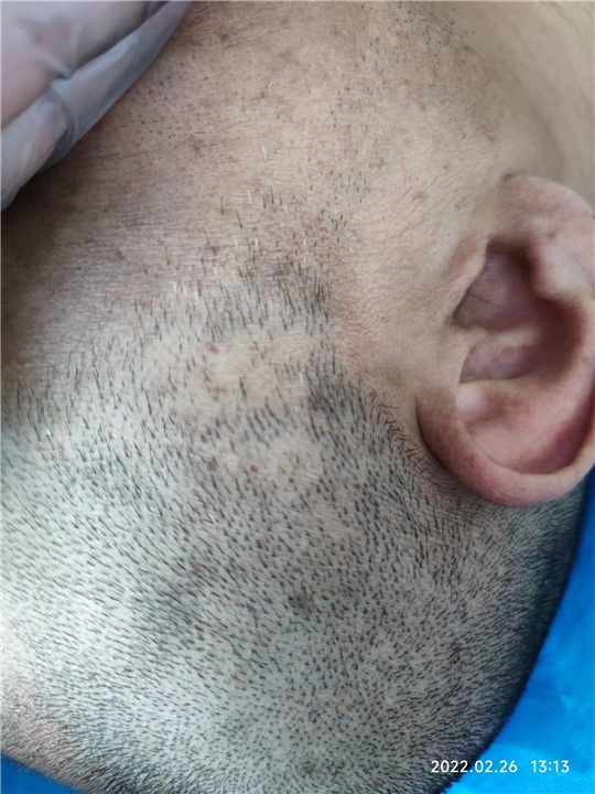 【纹发】**切除发现的雄脱？纹发能帮助脱发吗？-秃乐纹发-