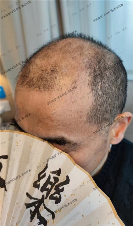 【北京纹发电话】如何选择纹发机构