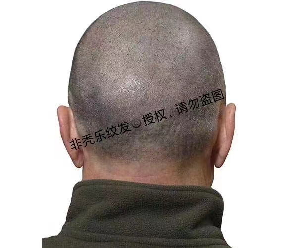 纹发和植发的区别？更多的人选择天津纹发
