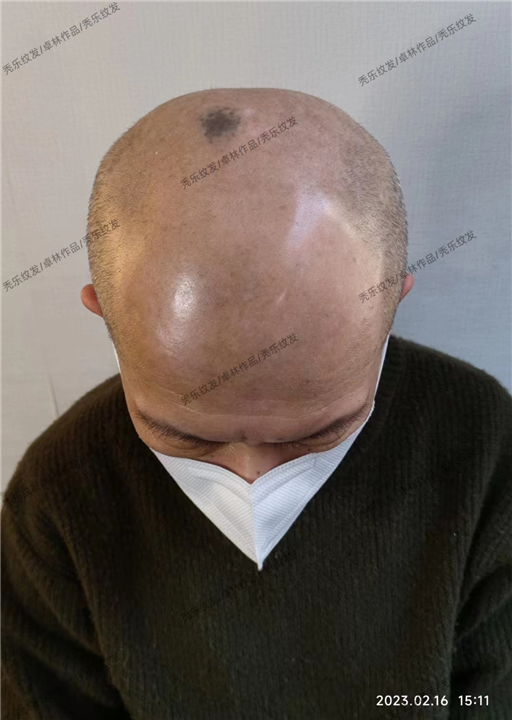 【北京纹发】头皮纹发、戴假发选择哪个好？