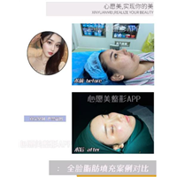 心愿美整容APP告诉你额头脂肪填充的注意事项