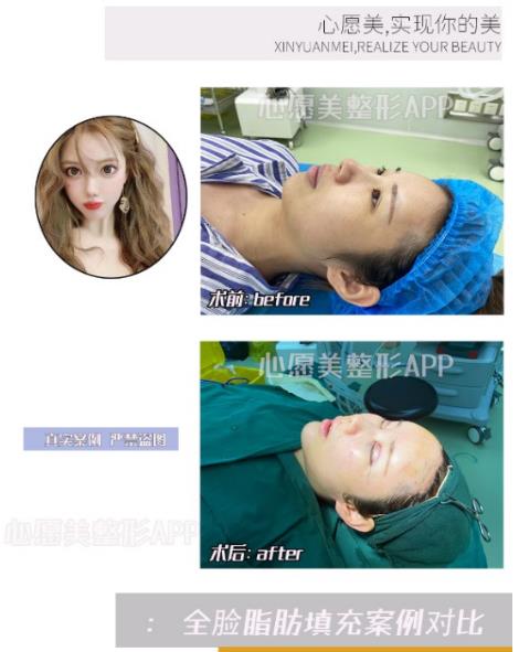 上海全脸脂肪填充整形哪家做的效果好