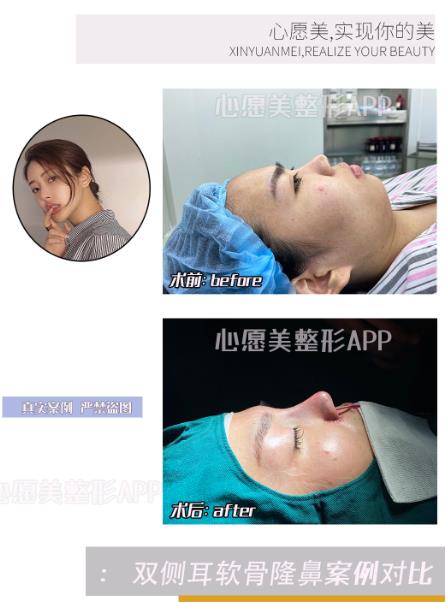 整形APP排行推荐上海自体组织隆鼻的价格