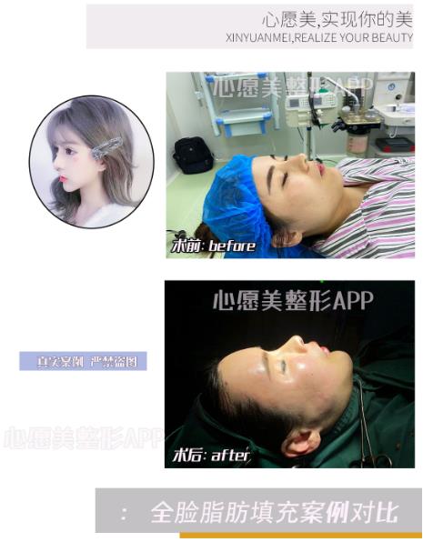 做面部自体脂肪填充需要注意什么?
