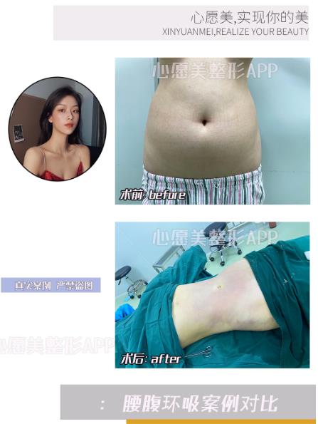 整容平台app推荐腹部抽脂多少钱多久恢复正常