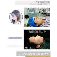 做面部自体脂肪填充需要注意什么?