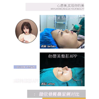 整形app推荐知识鼻综合手术